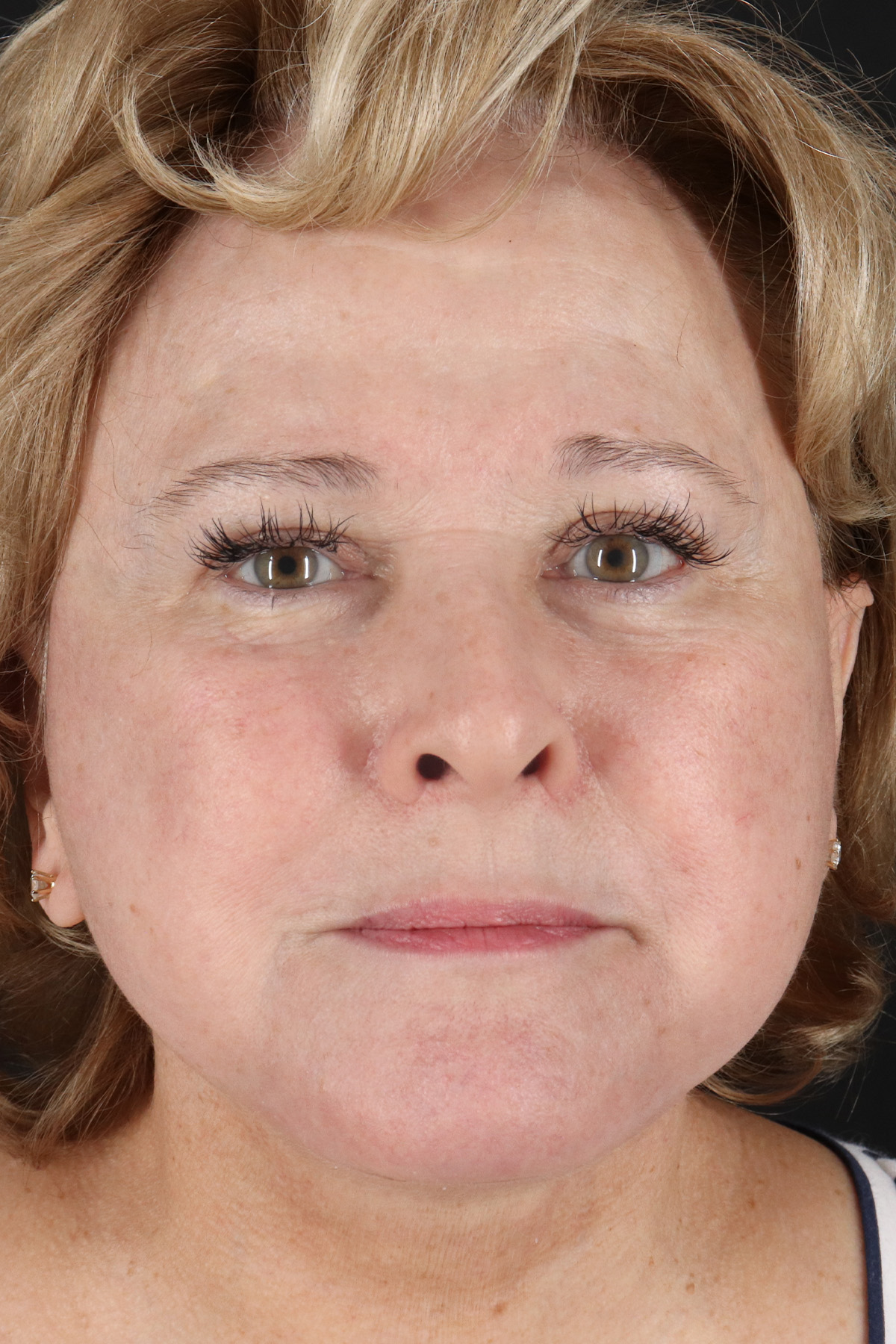 Facelift Before & After Patient #5392