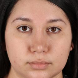 Neck Lift Before & After Patient #5395