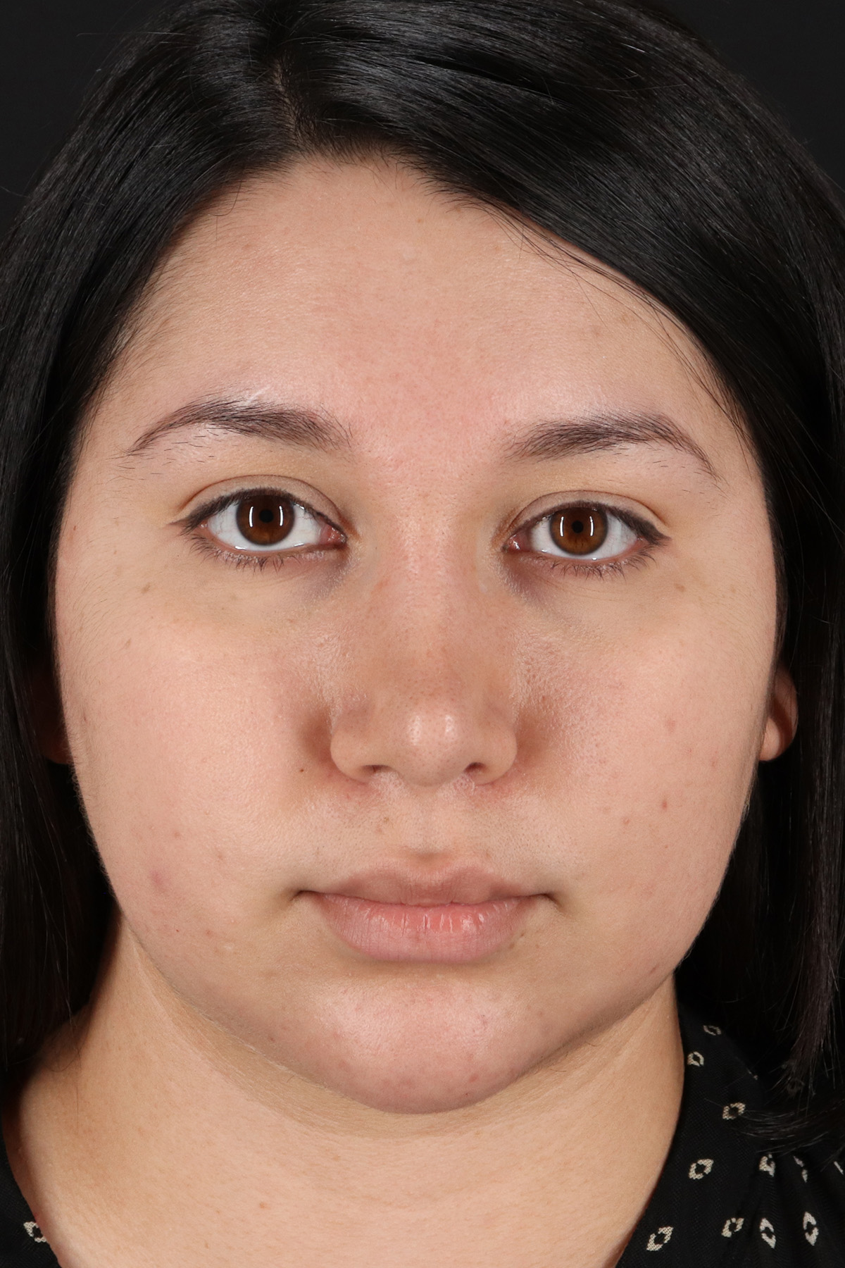 Neck Lift Before & After Patient #5395