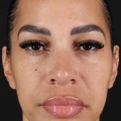 Chin Implant Before & After Patient #5390
