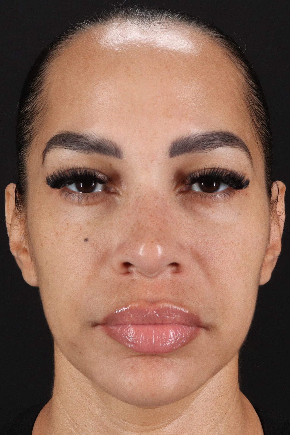 Chin Implant Before & After Patient #5390