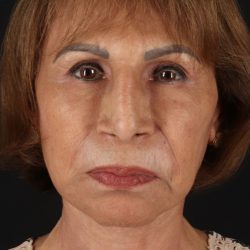 Facelift Before & After Patient #5394