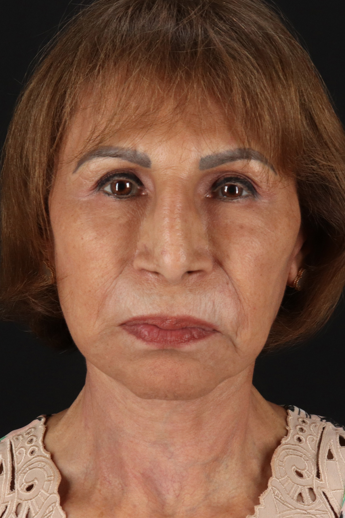 Facelift Before & After Patient #5394