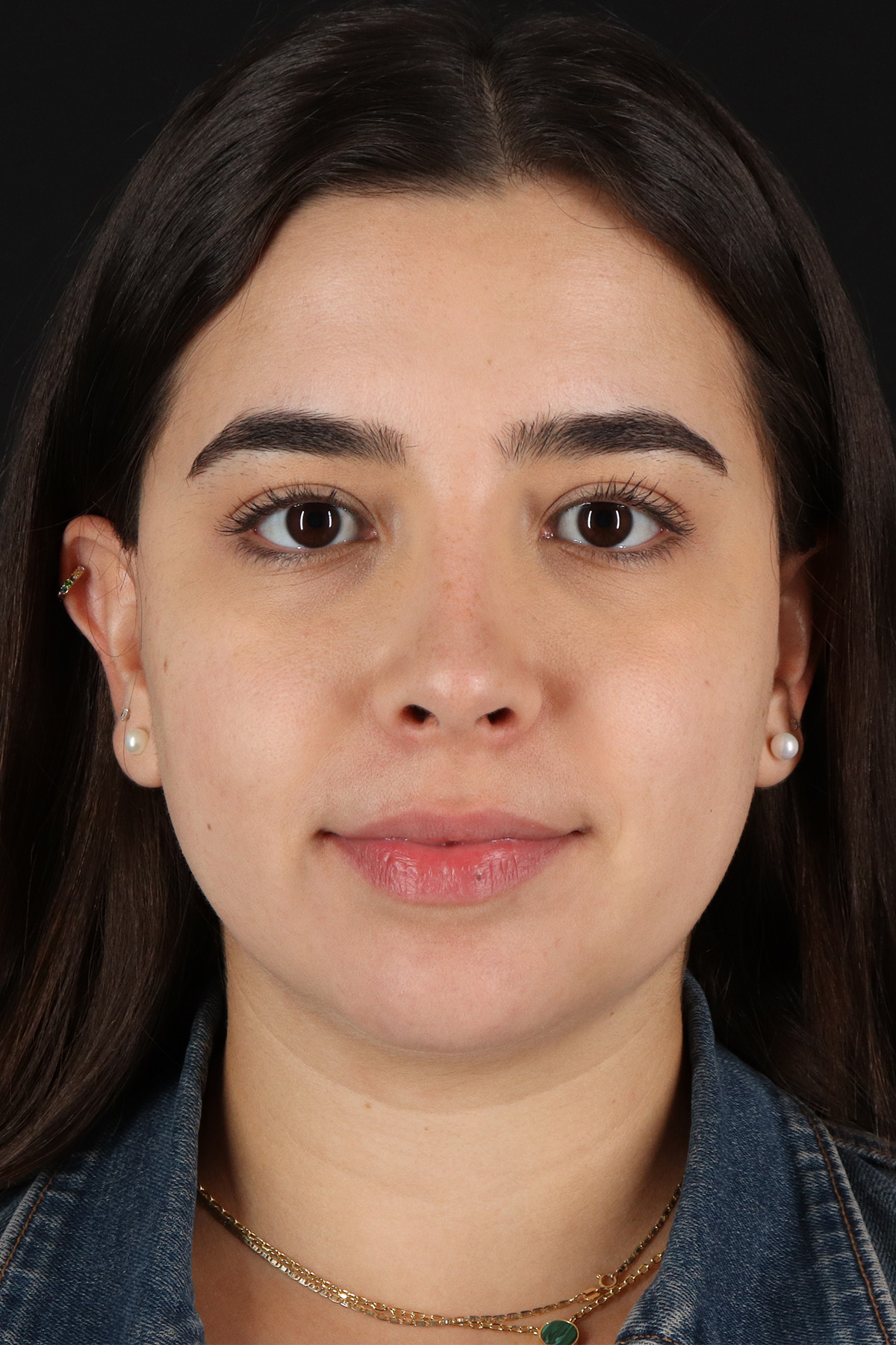 Chin Implant Before & After Patient #5391