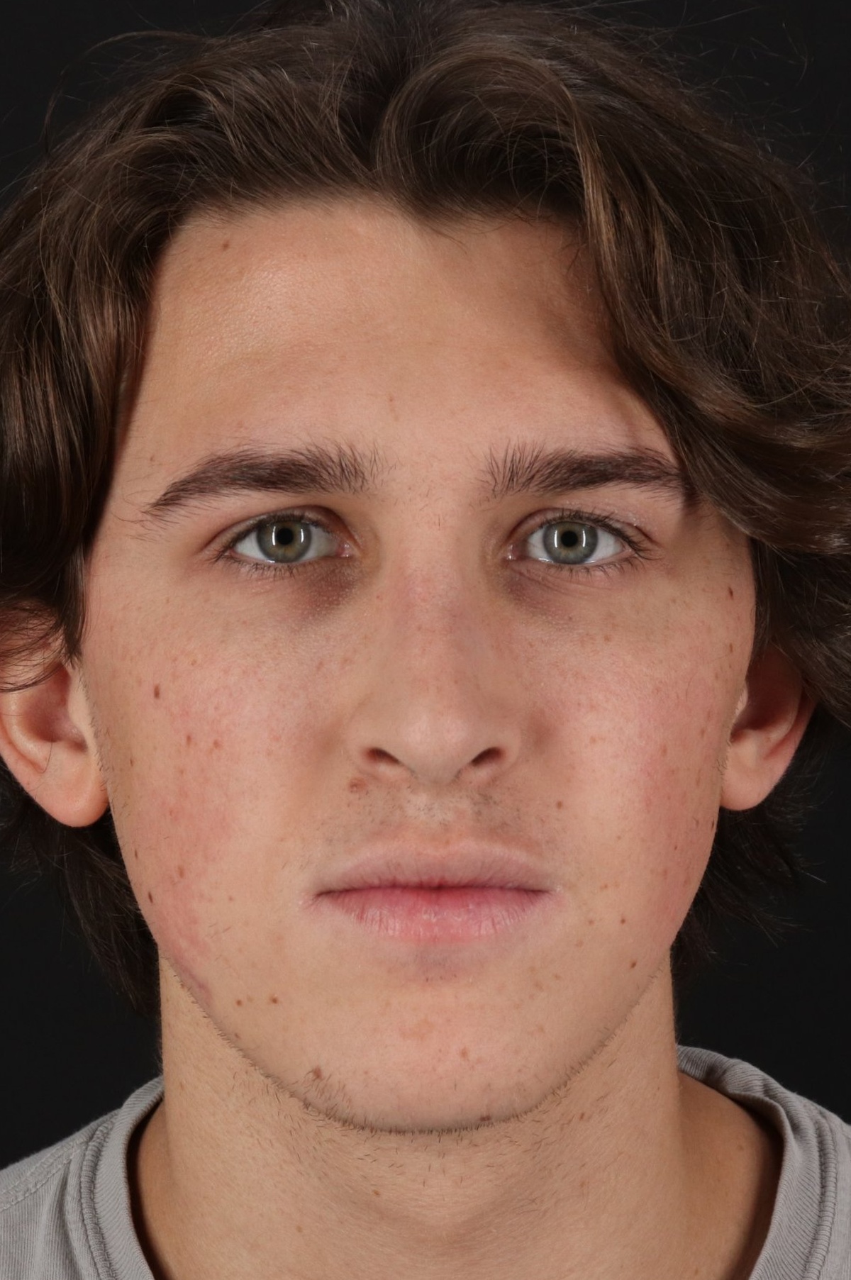 Rhinoplasty Before & After Patient #5515