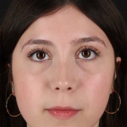 Rhinoplasty Before & After Patient #5575