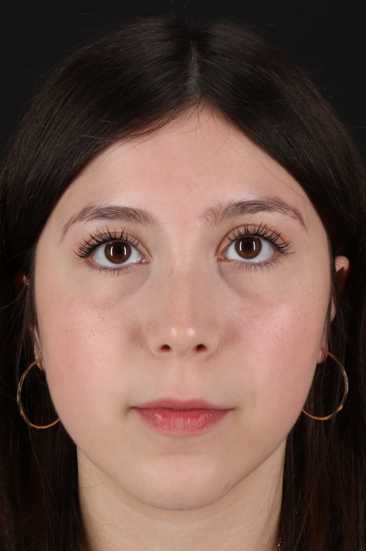 Rhinoplasty Before & After Patient #5575