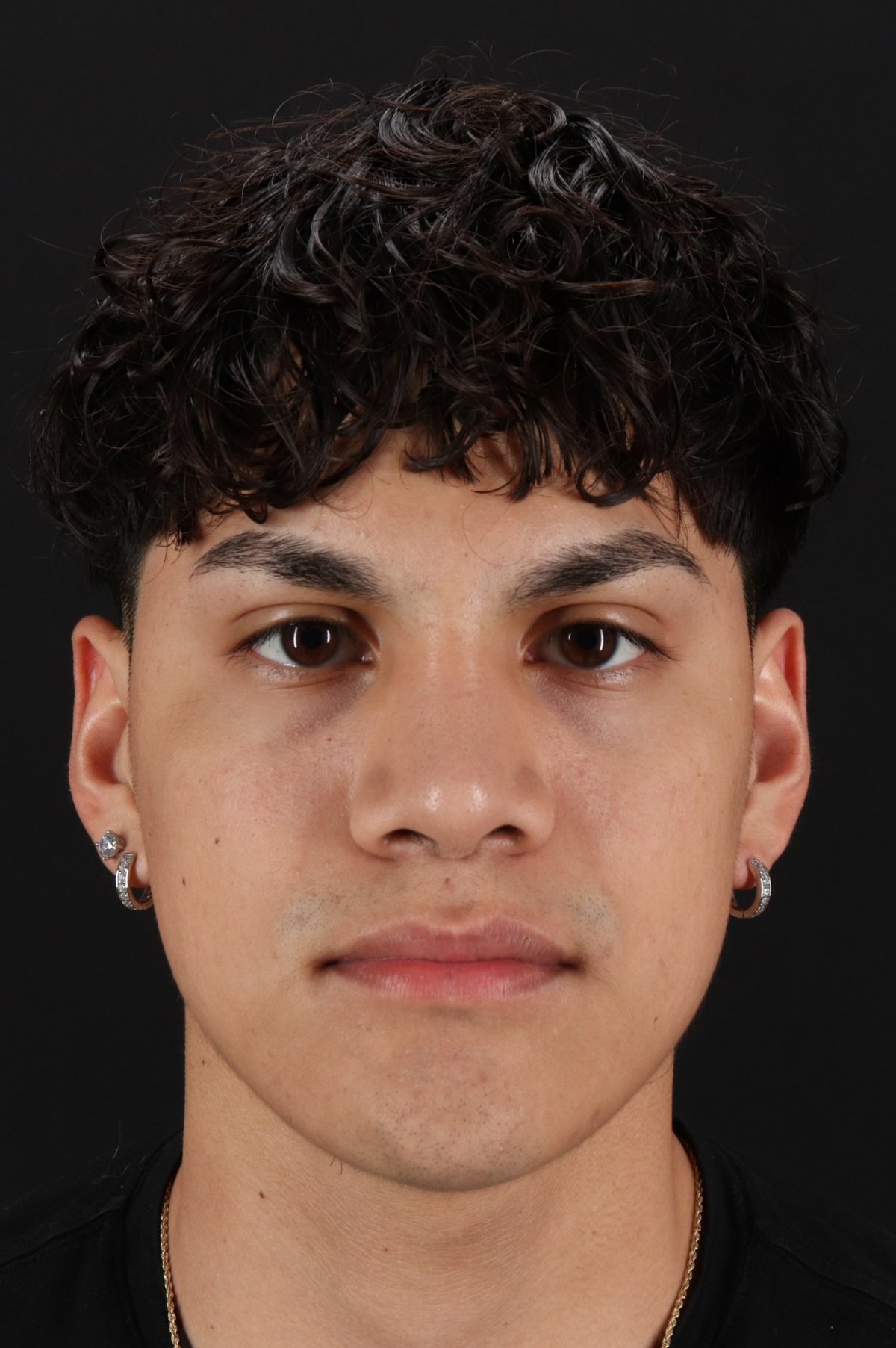 Rhinoplasty Before & After Patient #5517