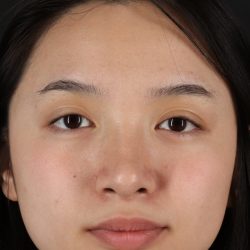 Rhinoplasty Before & After Patient #5573