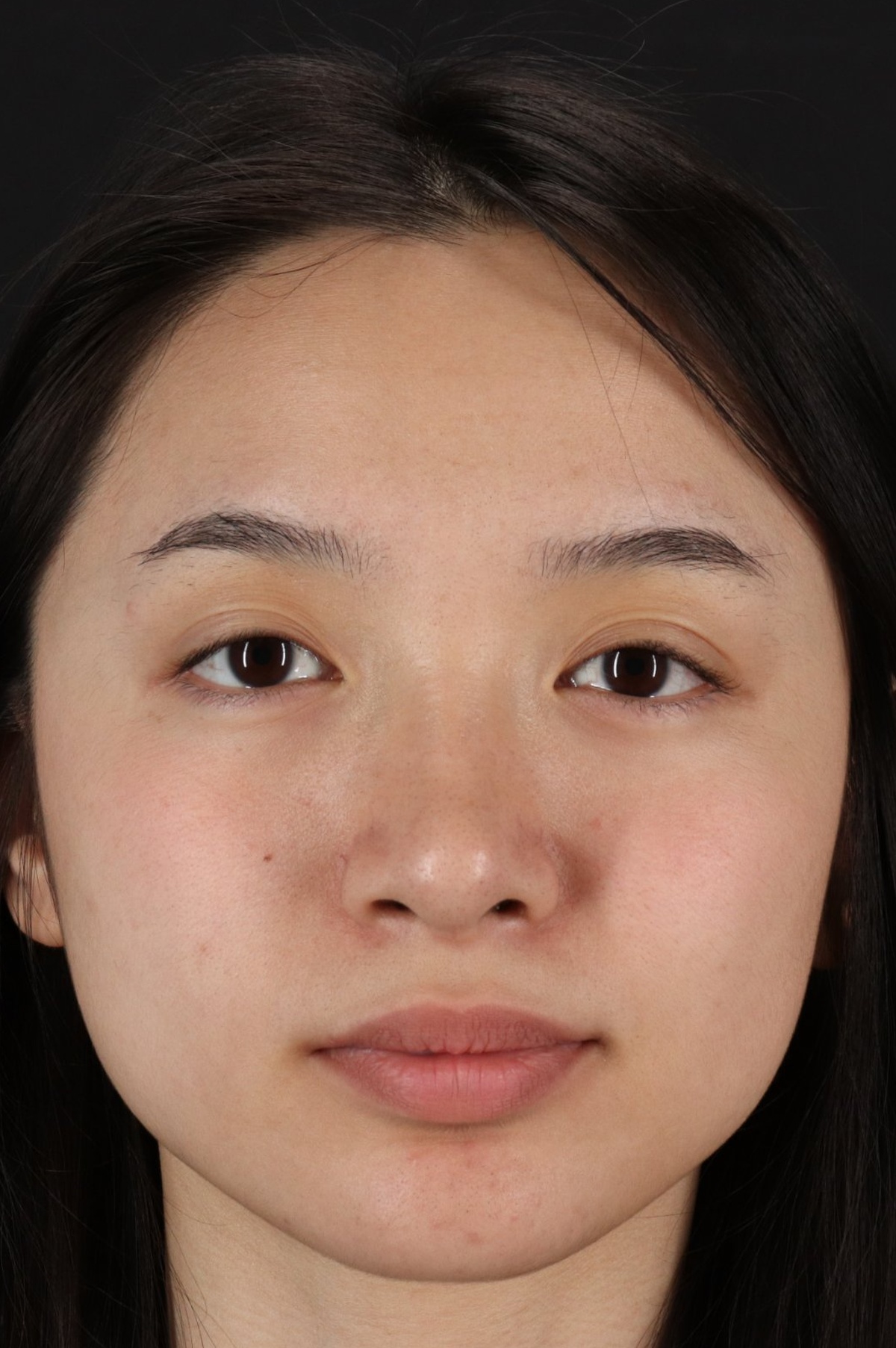 Rhinoplasty Before & After Patient #5573