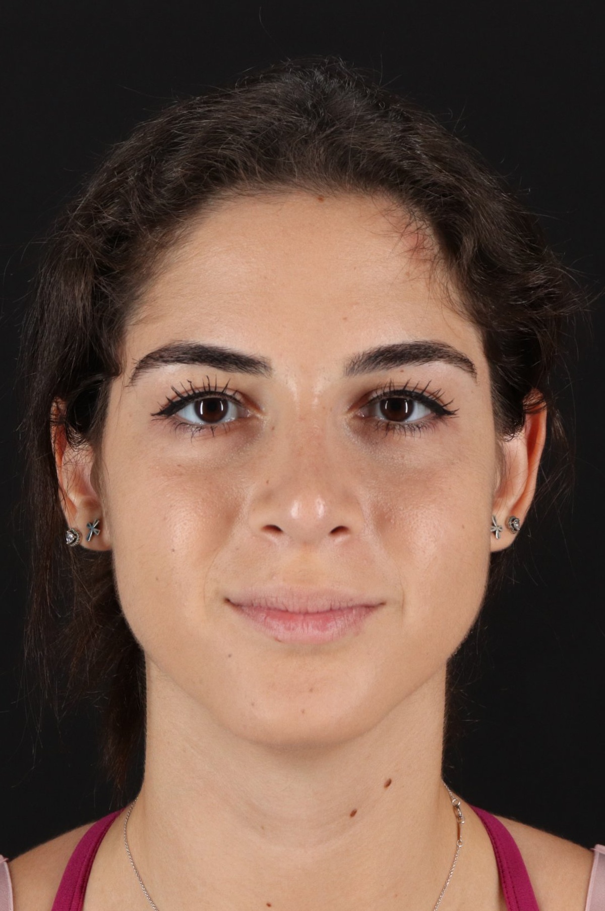 Rhinoplasty Before & After Patient #5572