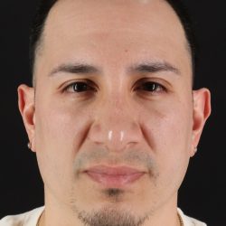 Rhinoplasty Before & After Patient #5518
