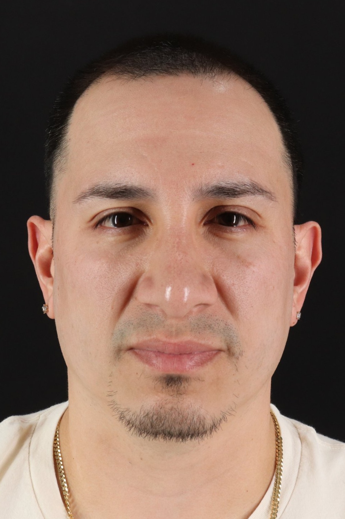 Rhinoplasty Before & After Patient #5518