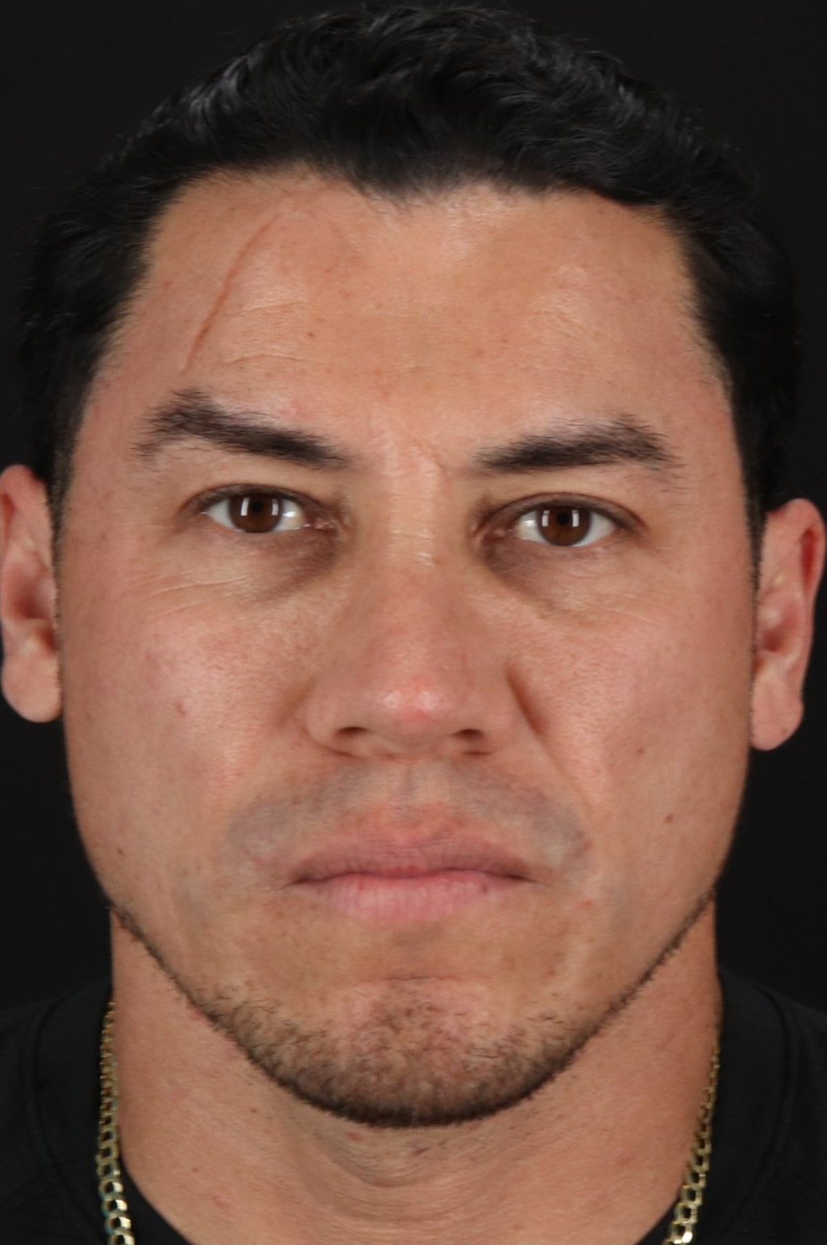 Rhinoplasty Before & After Patient #5519
