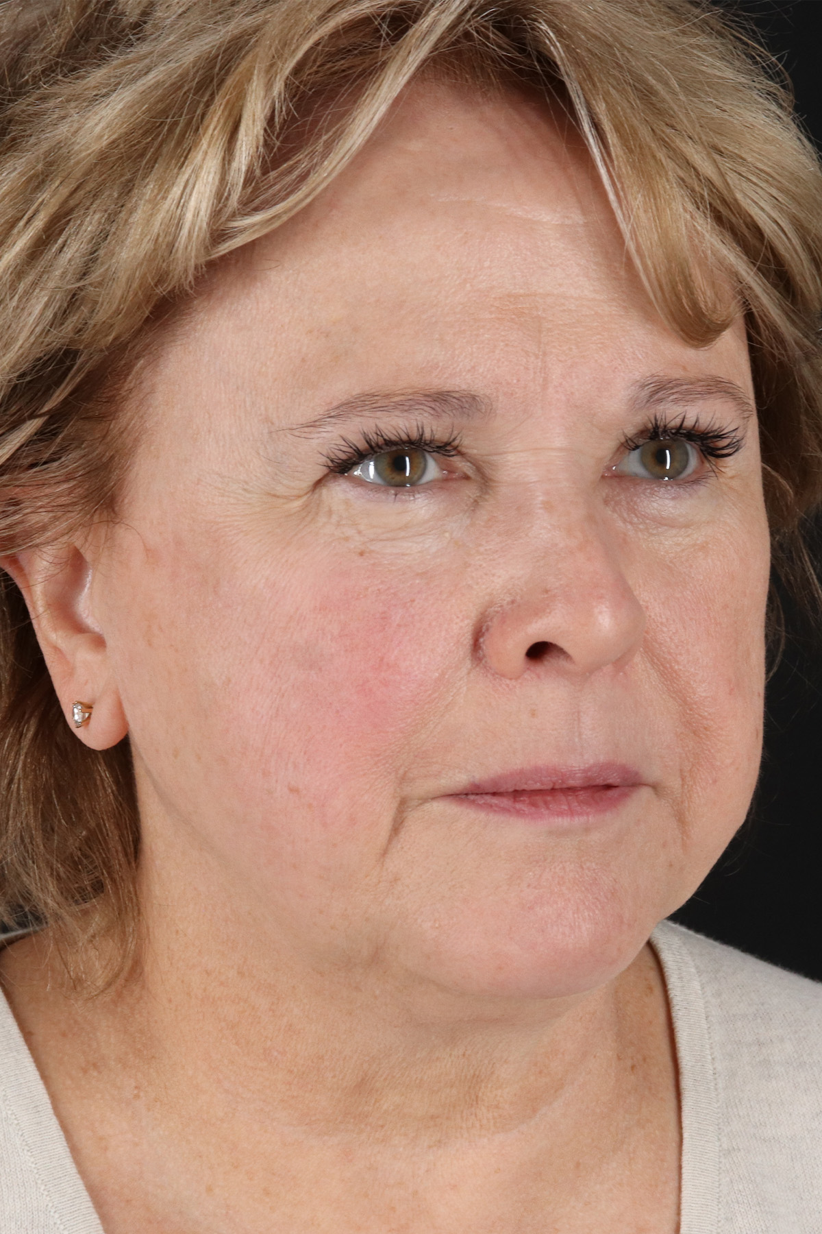 Facelift Before & After Patient #5392