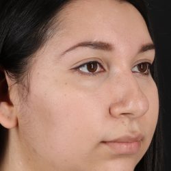 Neck Lift Before & After Patient #5395