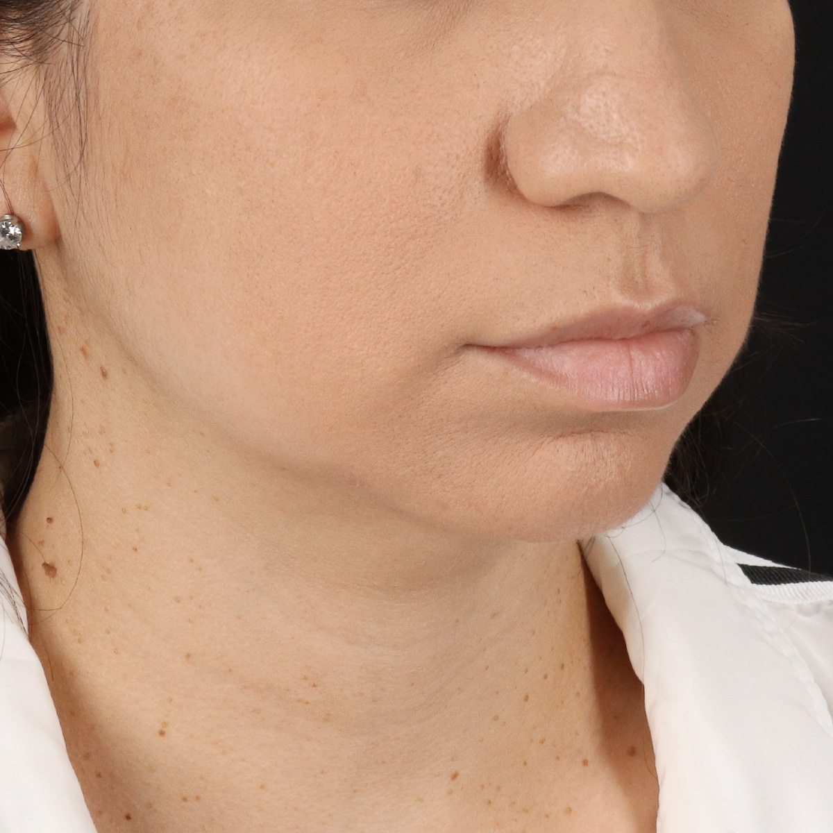 Neck Lift Before & After Patient #5396