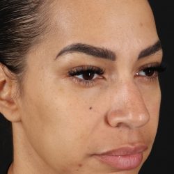 Chin Implant Before & After Patient #5390