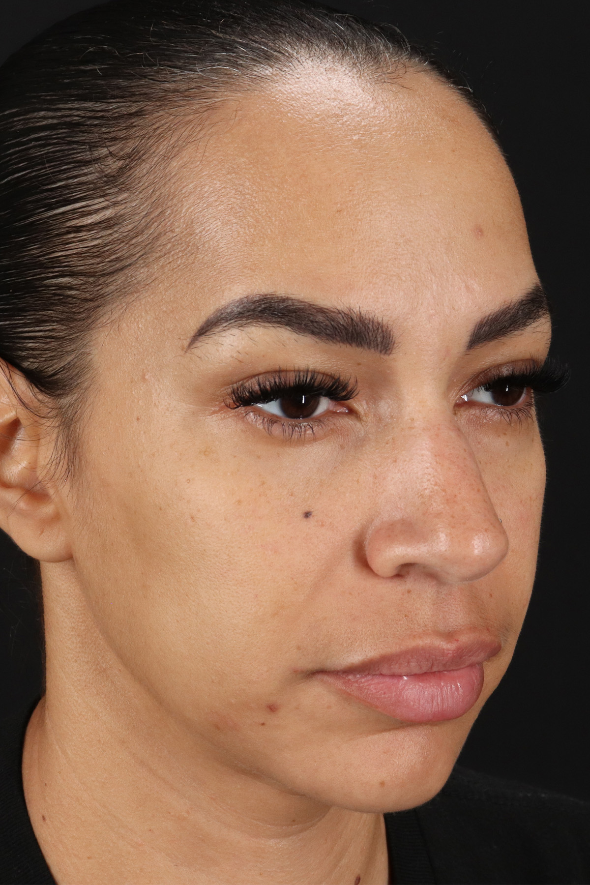 Chin Implant Before & After Patient #5390