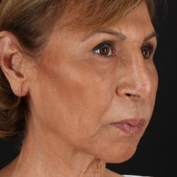 Facelift Before & After Patient #5394