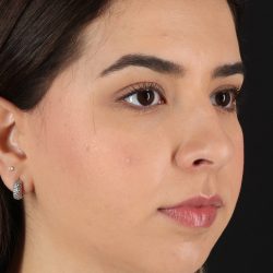 Chin Implant Before & After Patient #5391