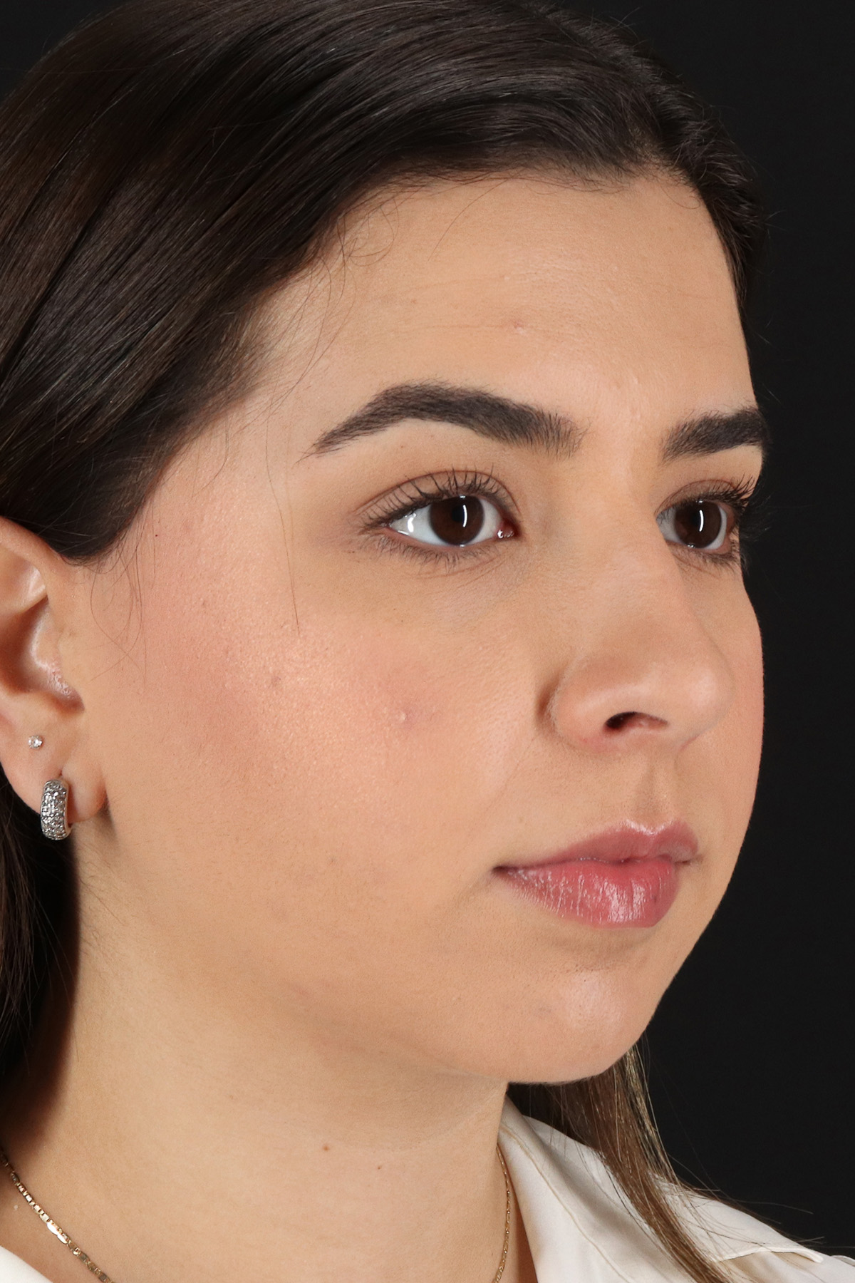 Chin Implant Before & After Patient #5391