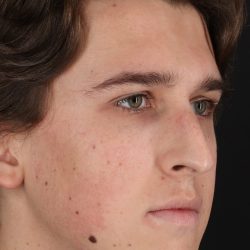 Rhinoplasty Before & After Patient #5515
