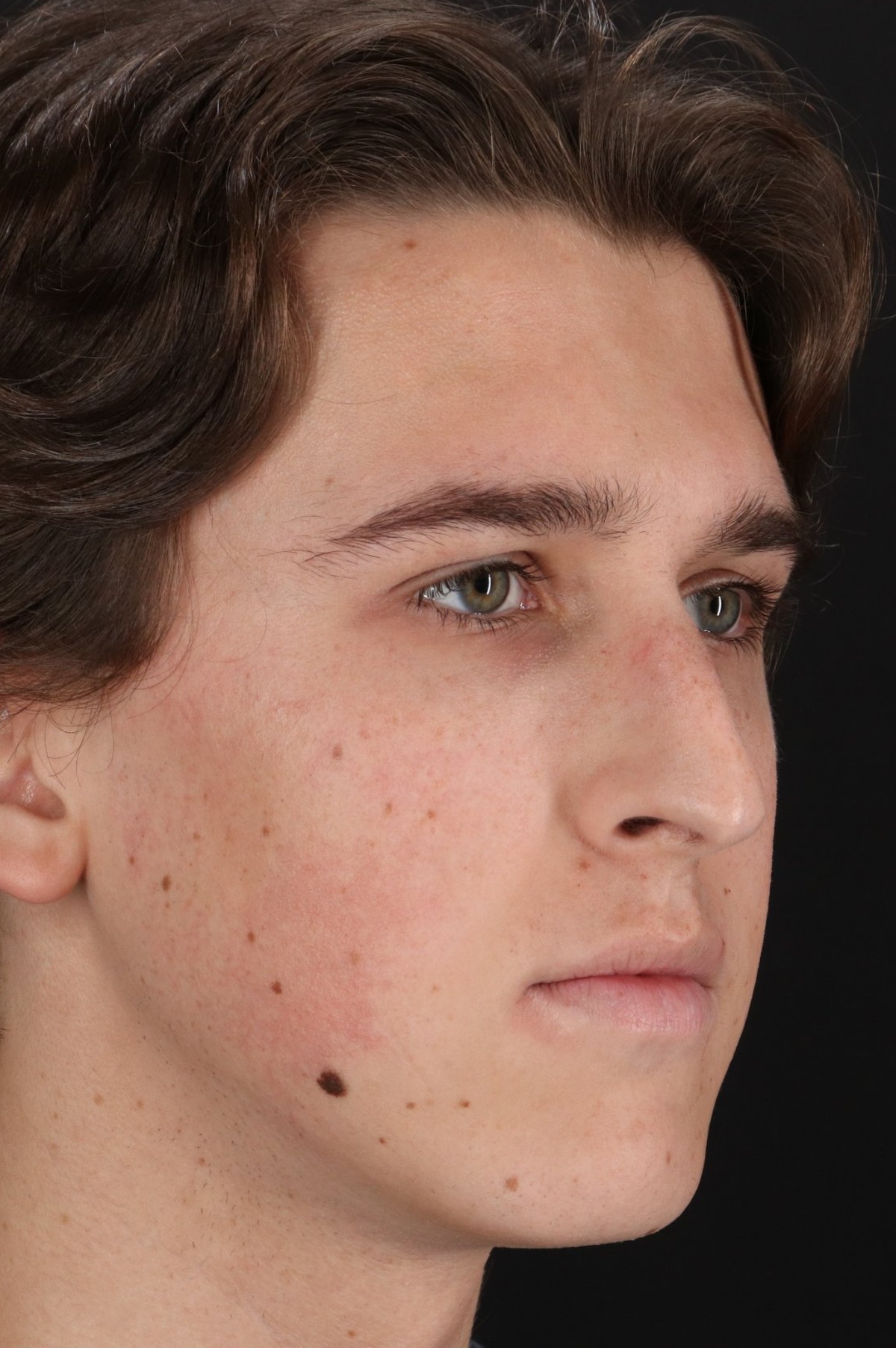 Rhinoplasty Before & After Patient #5515