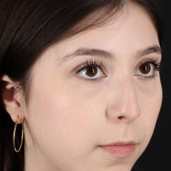Rhinoplasty Before & After Patient #5575
