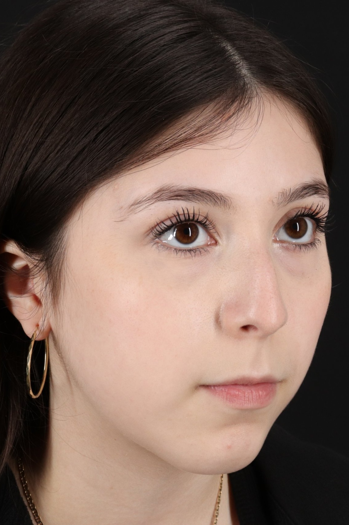 Rhinoplasty Before & After Patient #5575