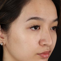 Rhinoplasty Before & After Patient #5573