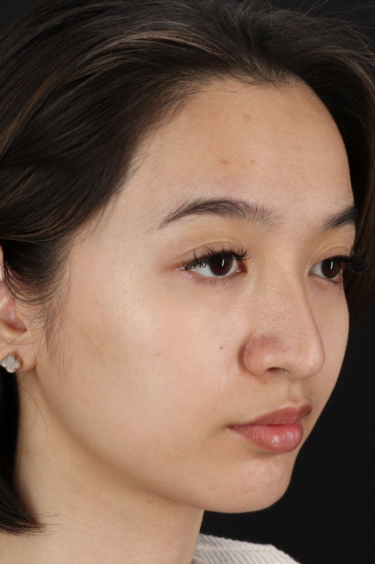 Rhinoplasty Before & After Patient #5573