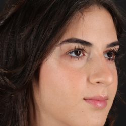 Rhinoplasty Before & After Patient #5572