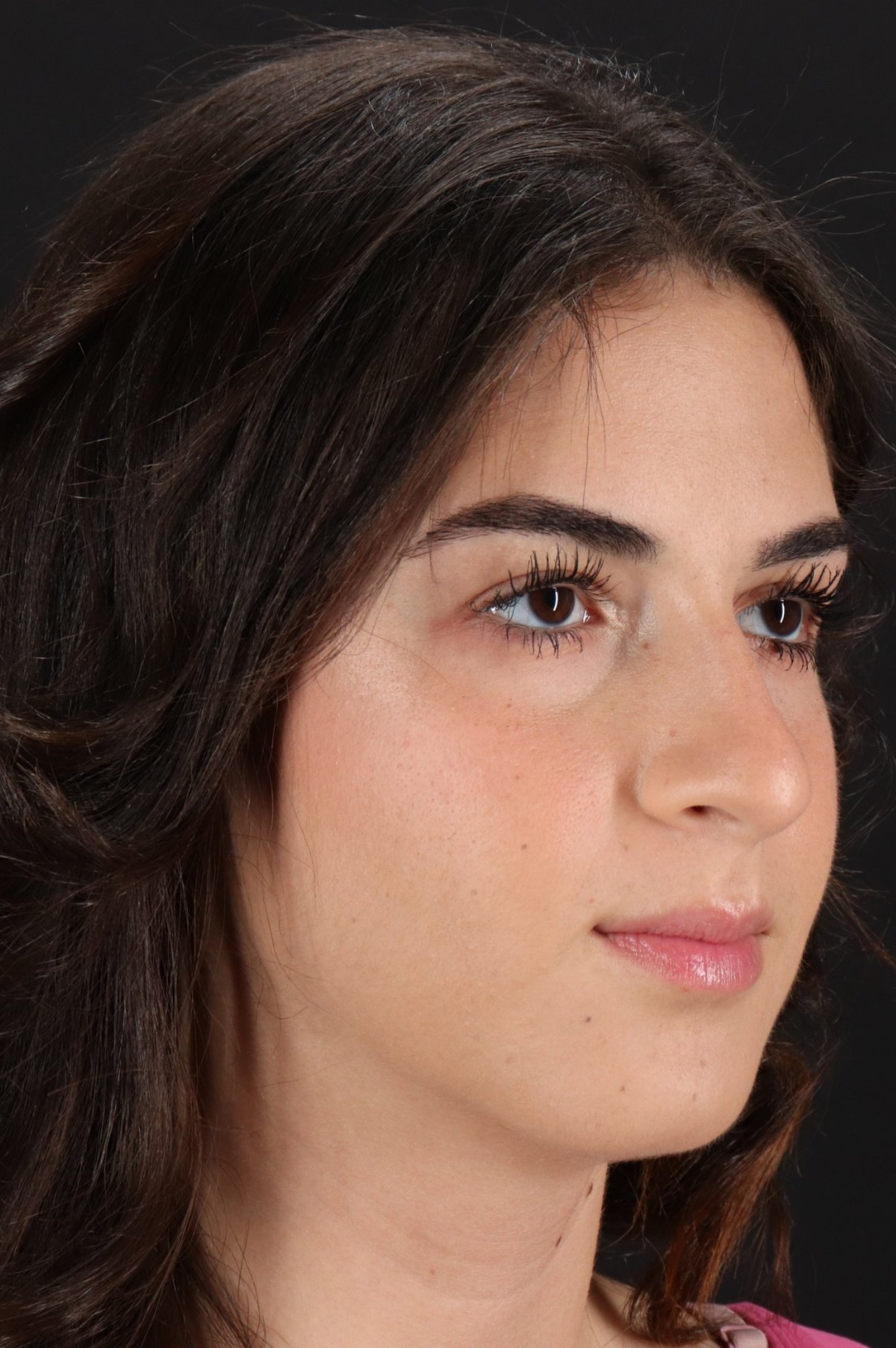 Rhinoplasty Before & After Patient #5572