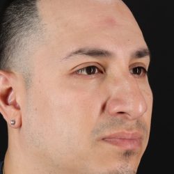 Rhinoplasty Before & After Patient #5518