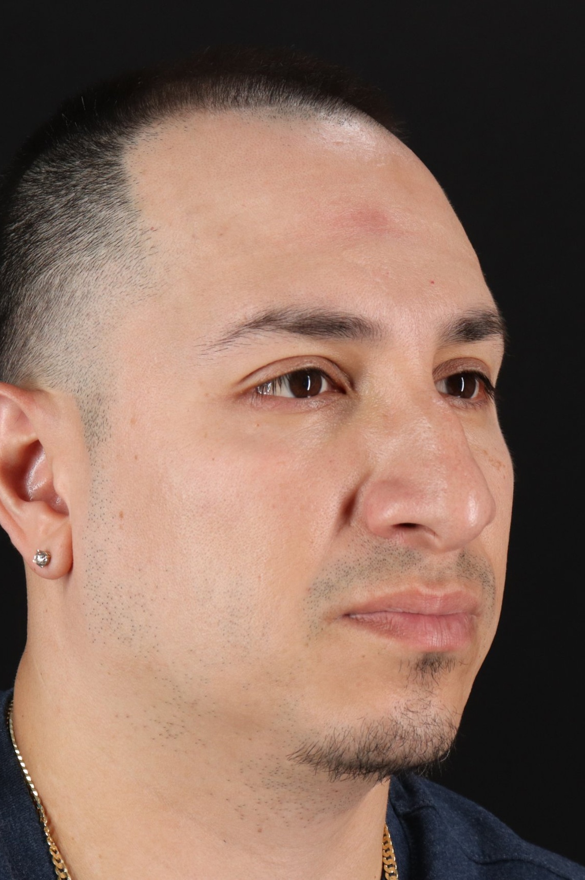 Rhinoplasty Before & After Patient #5518