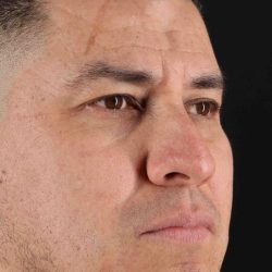 Rhinoplasty Before & After Patient #5519
