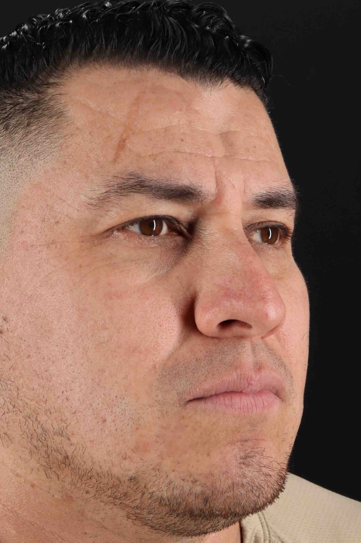 Rhinoplasty Before & After Patient #5519