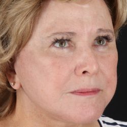 Facelift Before & After Patient #5392