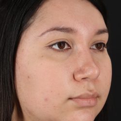 Neck Lift Before & After Patient #5395