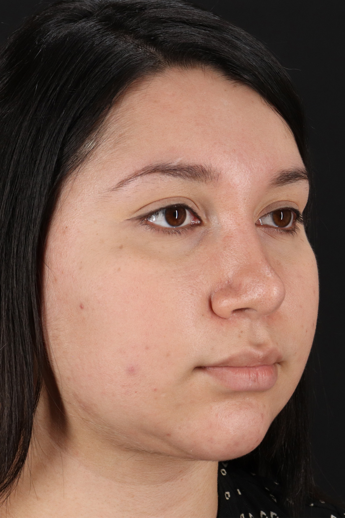 Neck Lift Before & After Patient #5395
