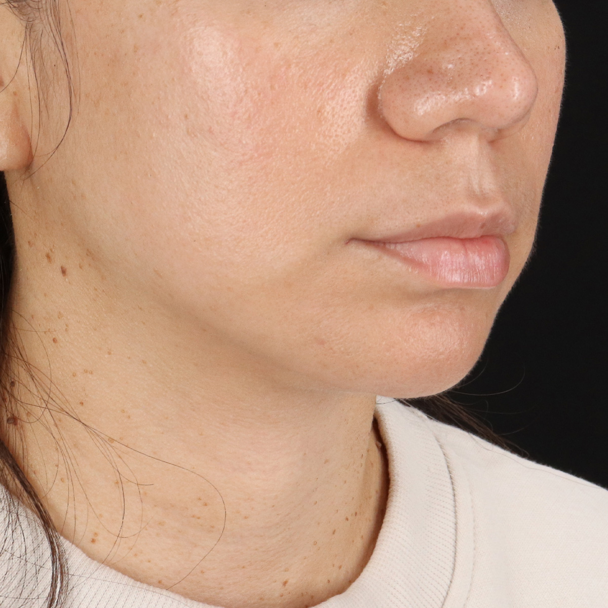 Neck Lift Before & After Patient #5396