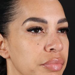 Chin Implant Before & After Patient #5390