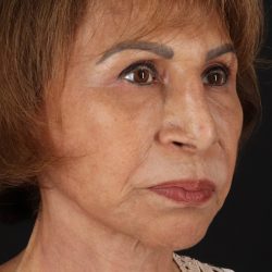 Facelift Before & After Patient #5394