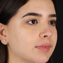 Chin Implant Before & After Patient #5391