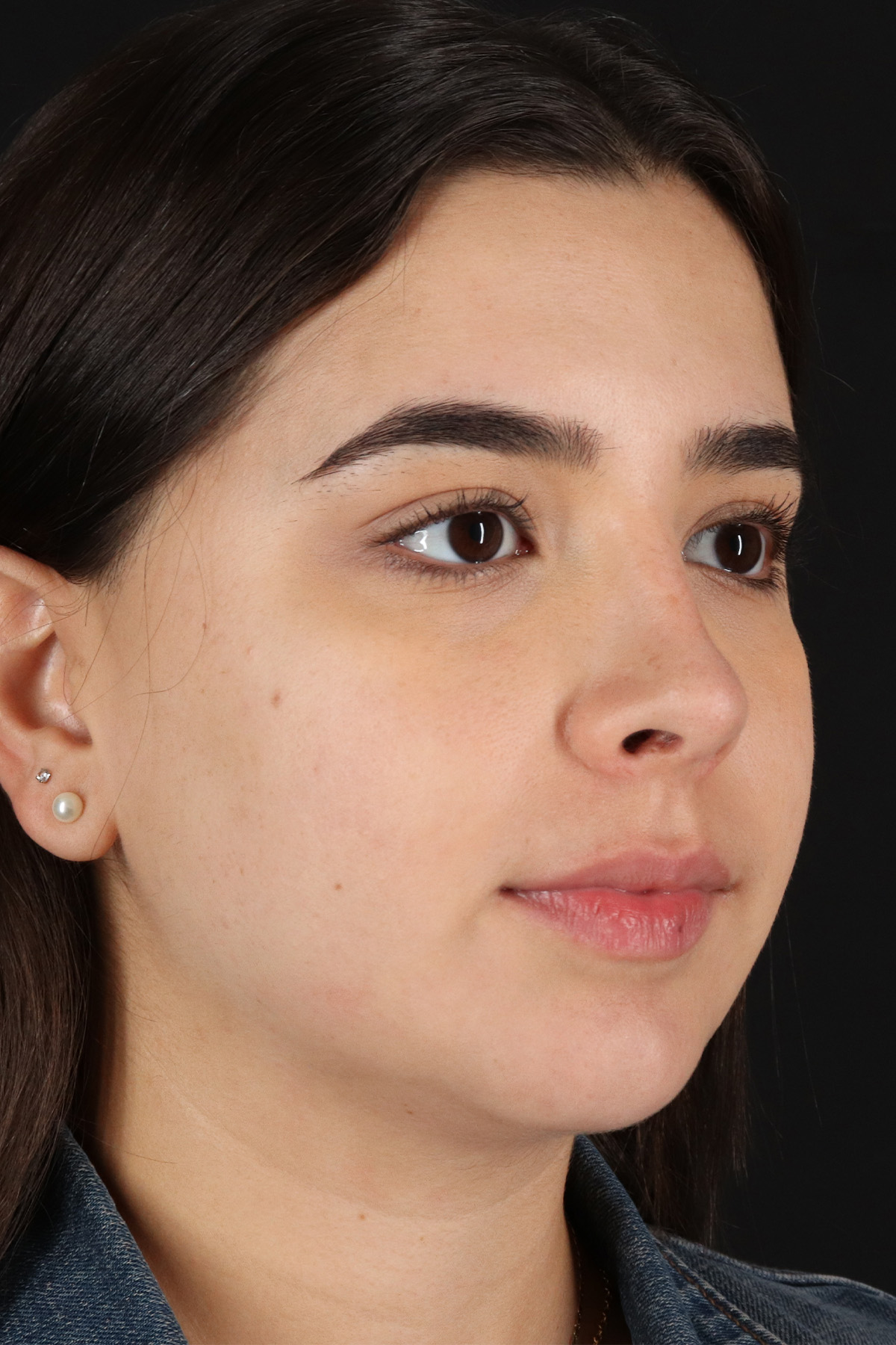 Chin Implant Before & After Patient #5391