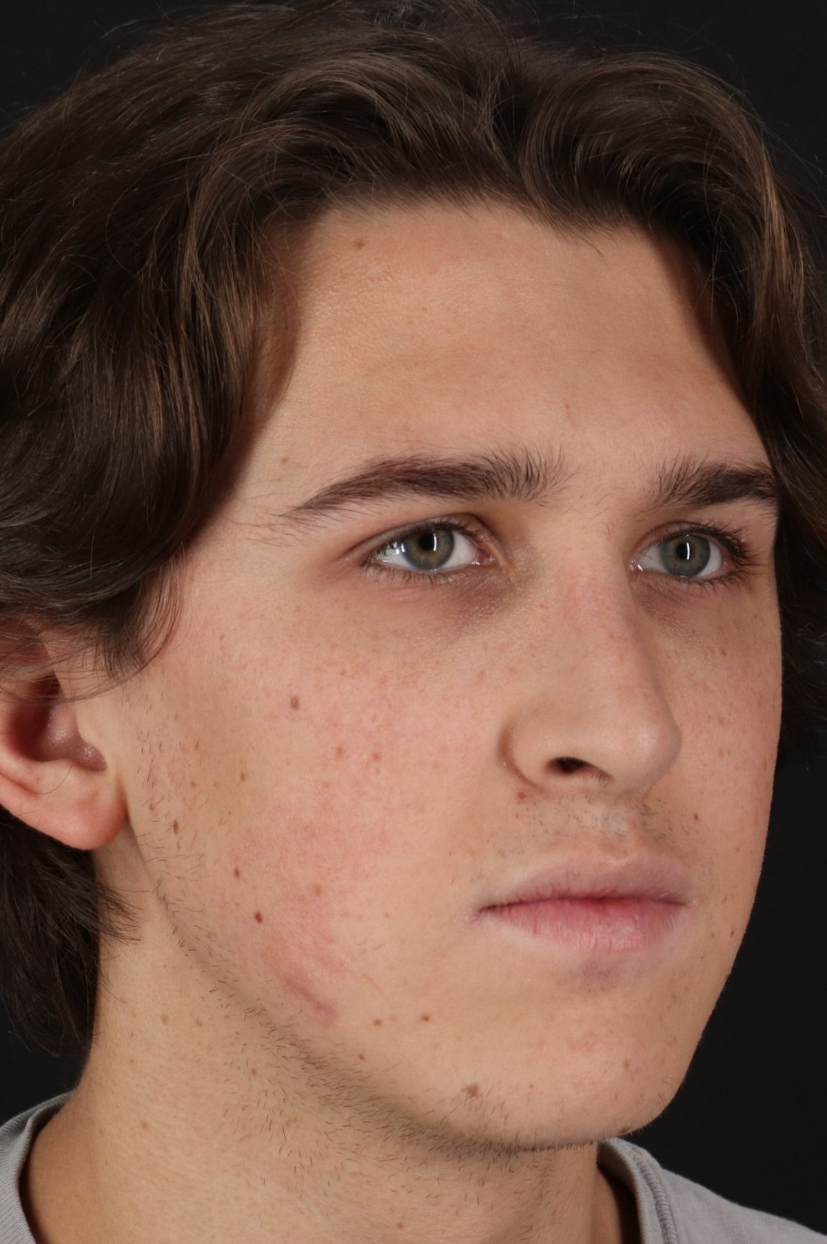 Rhinoplasty Before & After Patient #5515