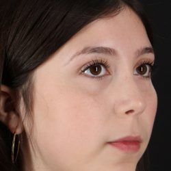 Rhinoplasty Before & After Patient #5575