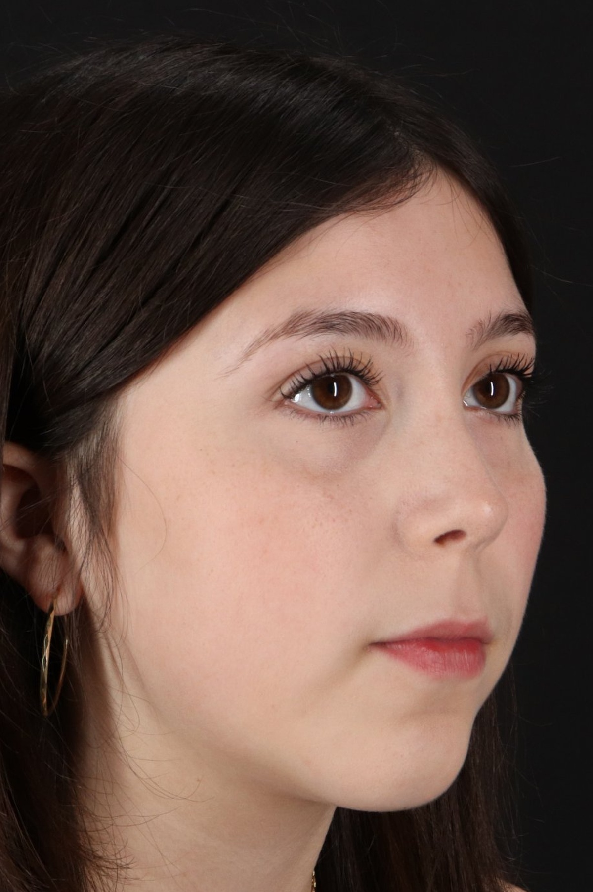 Rhinoplasty Before & After Patient #5575