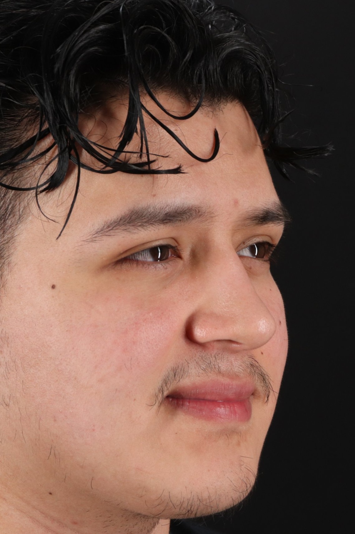 Rhinoplasty Before & After Patient #5516